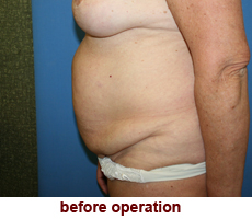 plastic-surgery-tummy-tuck